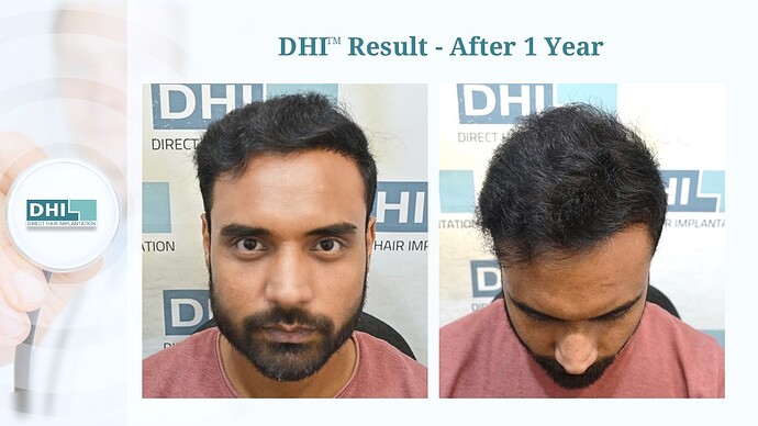 DHI India™ | NW 6 | 4,473 Grafts | 1-Year Hair Transplant Result photo