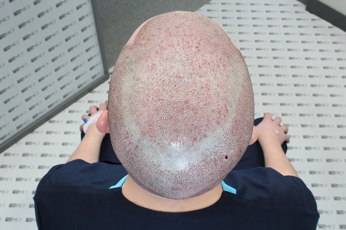 ASMED, Istanbul: 5,071 Manual FUE Grafts 0/12 Months photo