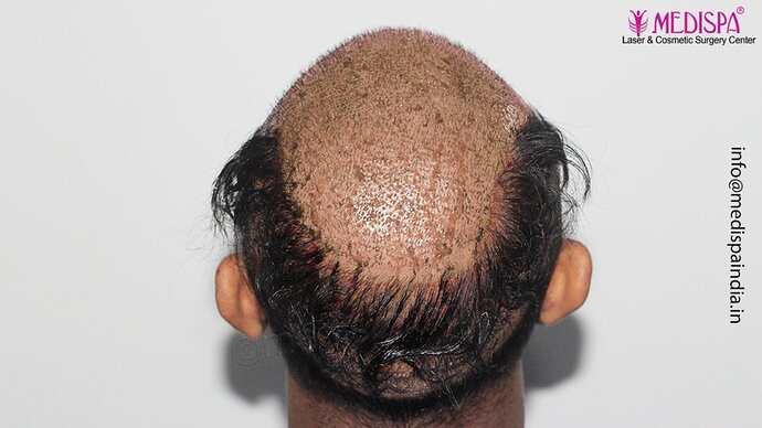 Dr. Suneet Soni - 5498 Grafts, 2 Years Result, Combine FUT + FUE + Beard Technique, NW-VI photo