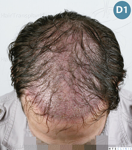 Dr. Jean Devroye, HTS Clinic / 4510 Combo (3510 FUT + 1000 FUE) Repair / 1 session photo