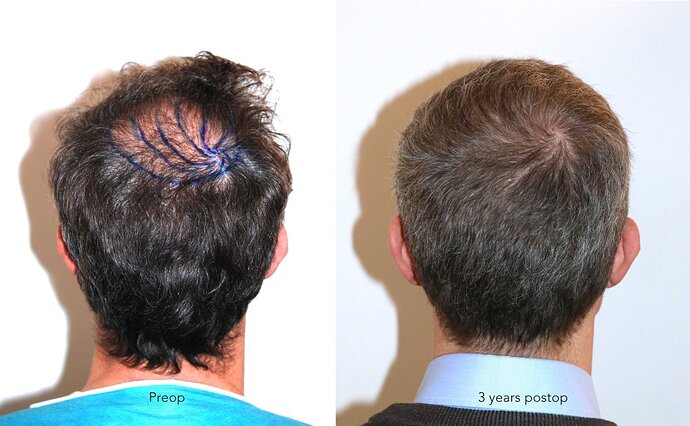 Case performed by Dr. Feriduni – 3883 FU in 1 procedure photo