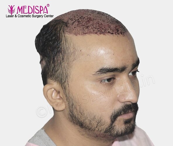 Dr. Suneet Soni - 4500 Grafts, Combine FUT + FUE + Beard Technique , NW- IV photo