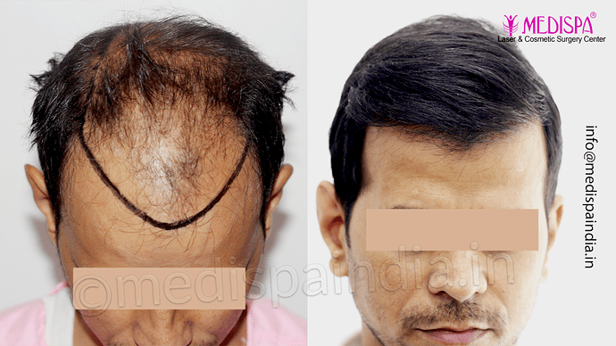 Dr. Suneet Soni - 4533 Grafts, Combine FUT + FUE Technique , NW-IV/V photo