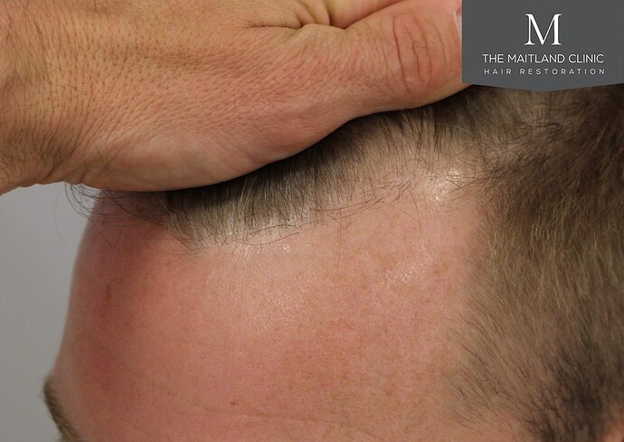 Dr Ball - The Maitland Clinic 1204 Grafts By FUE photo