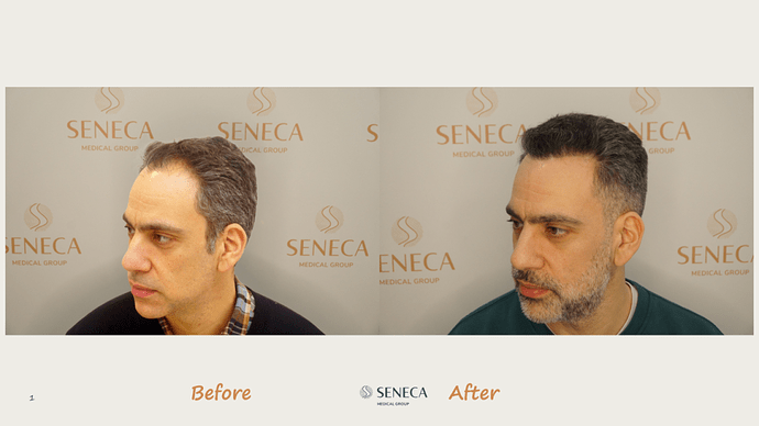 Seneca Medical Group - 2065 grafts with Direct Fue photo