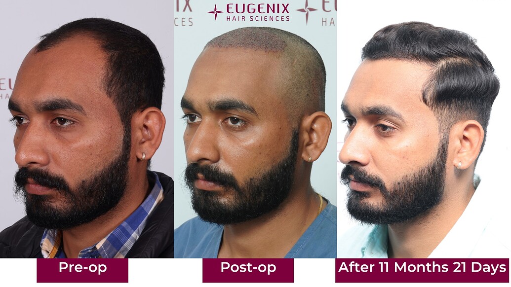 https://cdn.forumhairtransplant.com/optimized/3X/5/3/53143ab45e0deb350ff6b902abb3c6044084ed9e_2_1035x582.jpeg
