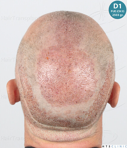 Dr Devroye + Dr Montesanti + Dr Jenard / 7015 grafts (4512 FUT + 2503 FUE) / 2 sessions photo