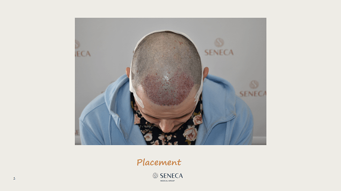 Seneca Medical Group - 1346 grafts with Direct Fue photo