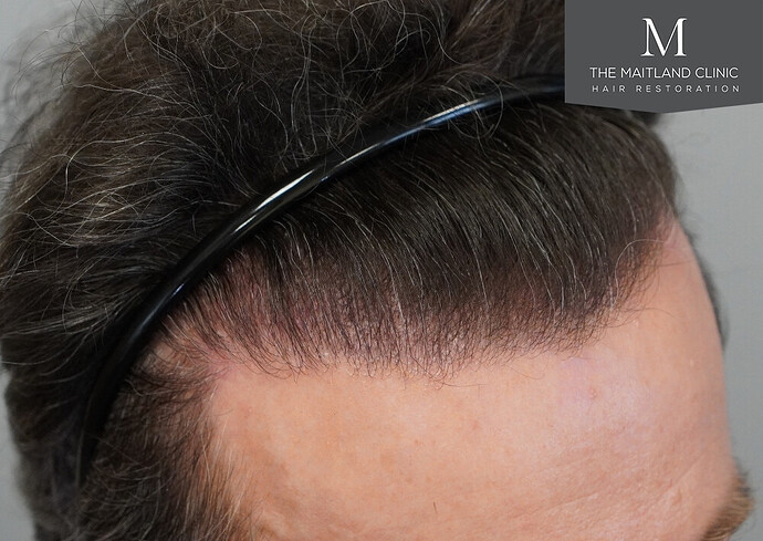Before and after results: 1694 grafts by FUE at The Maitland Clinic (Dr Edward Maitland Ball) photo