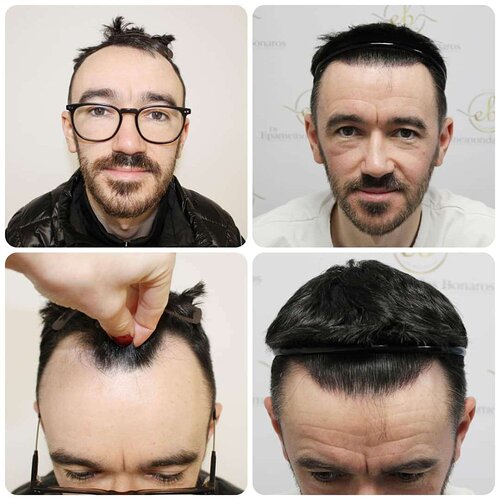 Dr Bonaros, Glasgow, UK / 1816 FUE grafts / 0-12 Months photo