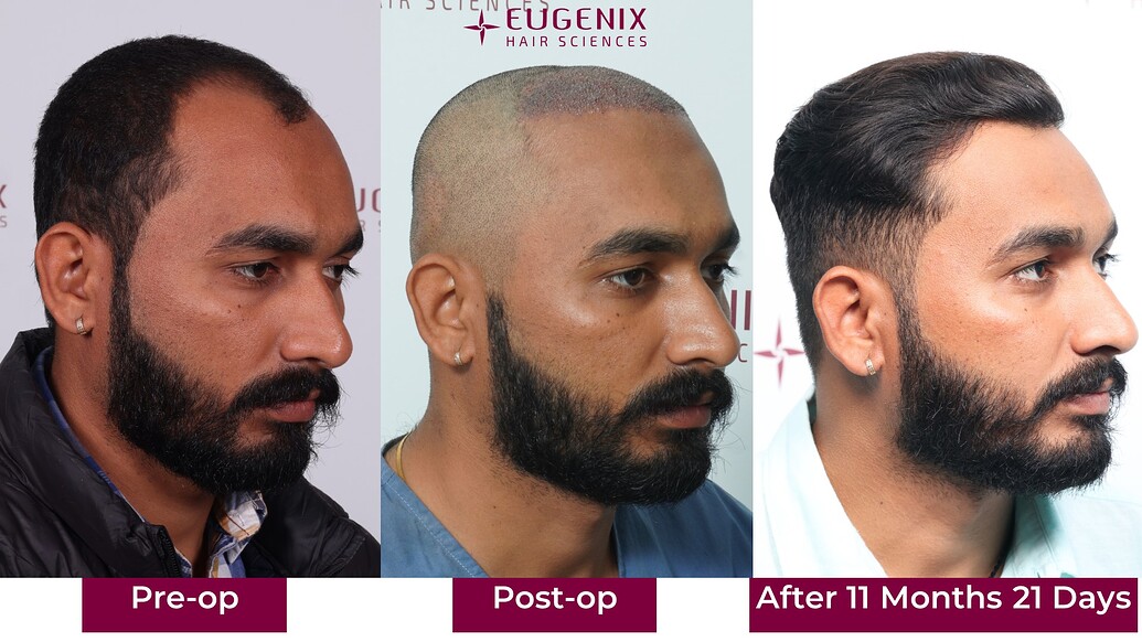https://cdn.forumhairtransplant.com/optimized/3X/5/3/53f7d0c080175797ca0e7e97b4aea554f3e45737_2_1035x582.jpeg