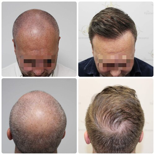 Dr Bonaros, Glasgow, UK / 4076 FUE grafts / 0-12 Months photo