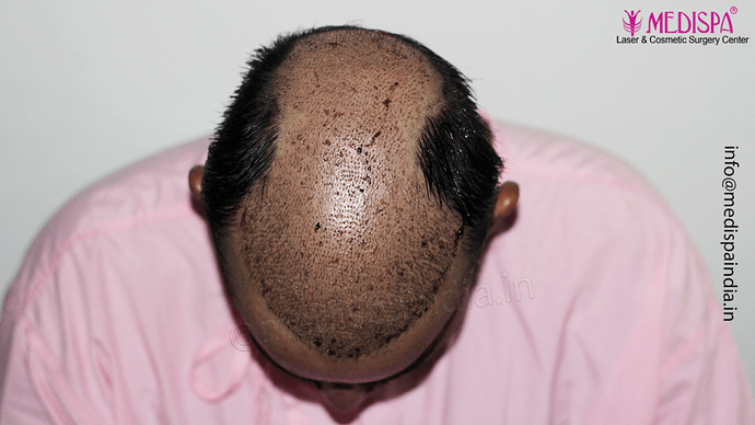 Dr. Suneet Soni - 4992 Grafts | 12-Month Result | Combination FUT + FUE + Beard photo