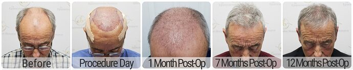 Dr Bonaros, Glasgow, UK / 3524 FUE grafts / 0-12 Months photo