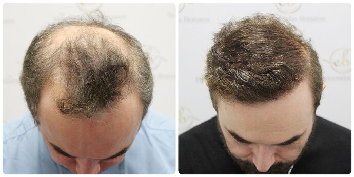 Dr Bonaros, Glasgow, UK / 3986 FUE grafts / 0-12 Months photo