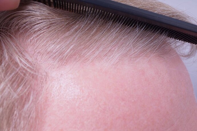 Dr B Farjo 2000g FUE (Frontal) photo