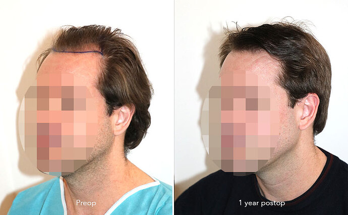Case performed by Dr. Feriduni – 3322 FU in 1 procedure photo