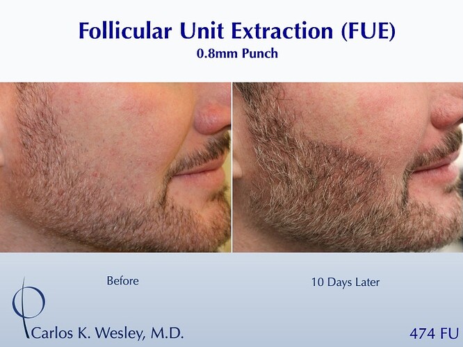 Formation of Beard (474 FUE beard grafts): Carlos K. Wesley, M.D. (NYC & LA) photo