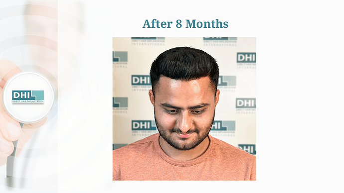 DHI India Result – 1784 Grafts photo