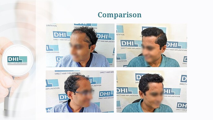 DHI India | NW Scale 6 | 4,127 Grafts | 9 Months DHI Hair Transplant Result photo