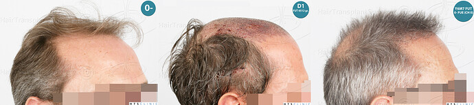 Dr Devroye + Dr Montesanti + Dr Jenard / 7015 grafts (4512 FUT + 2503 FUE) / 2 sessions photo