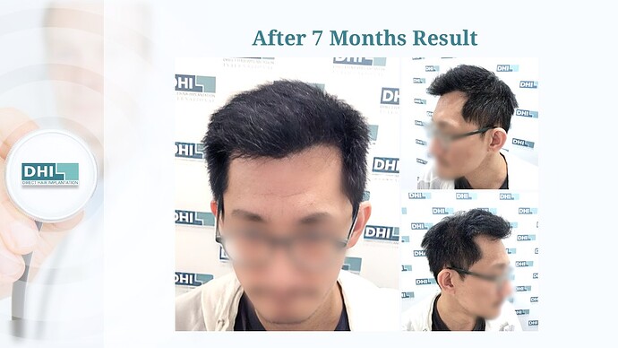 DHI India | NW 5 | 5,319 Grafts | 7-Months DHI Hair Transplant Results photo