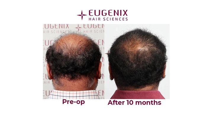 Eugenix Hair Sciences| NW 7 | 6309 Grafts | 10 Months Post-op| Dr. Pradeep Sethi photo