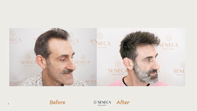 Seneca Medical Group - 1500 grafts with Direct Fue photo