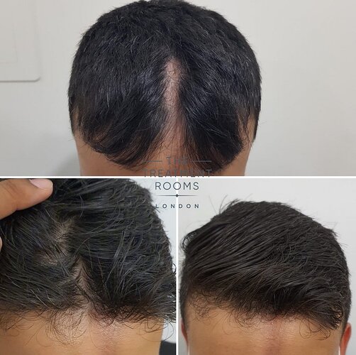 Hair Transplant Surgery for Linear Scleroderma 817 grafts photo