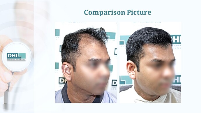 DHI India™ | NW 5 | 3,257 Grafts | 7 Months Hair Transplant Result photo