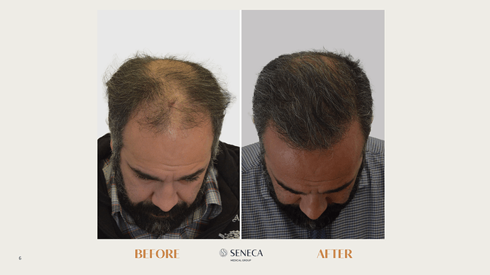 Seneca Medical Group - 1533 grafts with Direct FUE photo