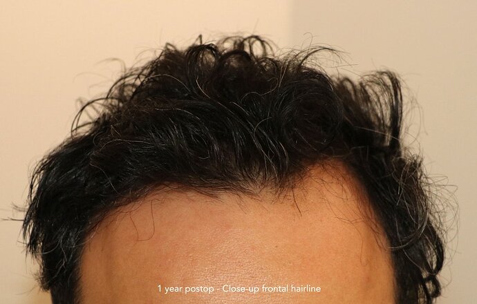 Case performed by Dr. Feriduni – 4485 FU in 1 day procedure photo