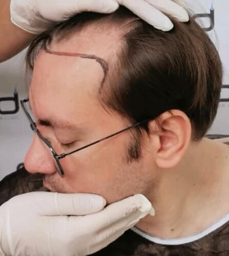 DR HAKAN DOGANAY/ 3600 GRAFTS / Implanter Pen+FUE photo