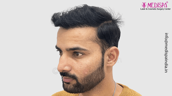Dr. Suneet Soni - 4046 Grafts | 12-Month Result | Combination FUT + FUE + Beard photo