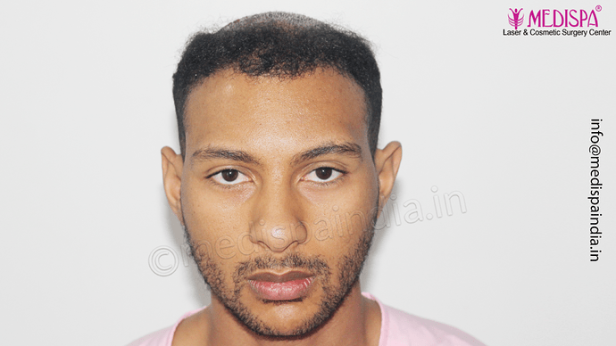 Dr. Suneet Soni - Afro Hair Transplant, 2 Sessions, 8355 Grafts, Combined FUT + FUE Technique, NW-VI, 5 Years Result photo