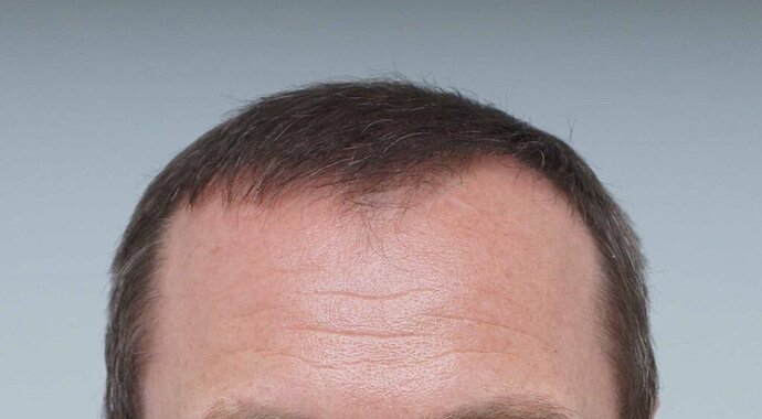 Dr B Farjo - FUE - 2091 Grafts photo