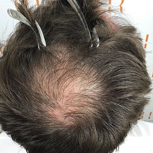 Dr. Bisanga & Dr. Kostis - 2955 FUE - 9 Months - Front & Crown photo