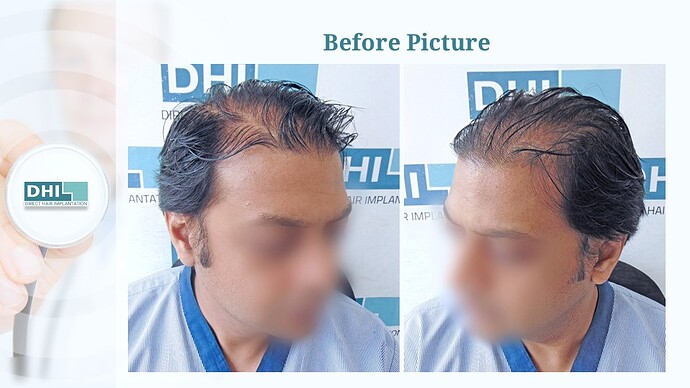 DHI India™ | 4,133 Grafts | Diffuse Alopecia | Full Coverage in 6 Months photo