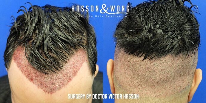 Dr. Hasson / 2,500 grafts / FUE / Hairline / 1 Year Post-op photo