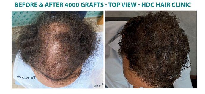 Hair Transplant Outcome with 4000 Grafts Across NW5 Zone – HDC Hair Clinic photo