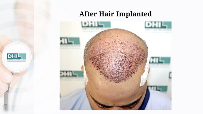 DHI India | NW Scale 5 | 2,923 Grafts | 9-Months DHI Hair Transplant Results photo