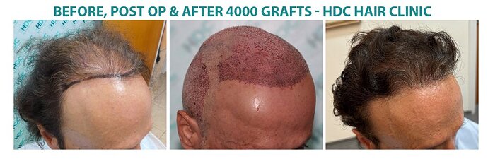 Hair Transplant Outcome with 4000 Grafts Across NW5 Zone – HDC Hair Clinic photo