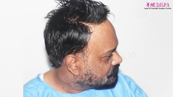 Dr. Suneet Soni - 4190 Grafts, Combine FUT + FUE + Beard Technique, NW- III photo