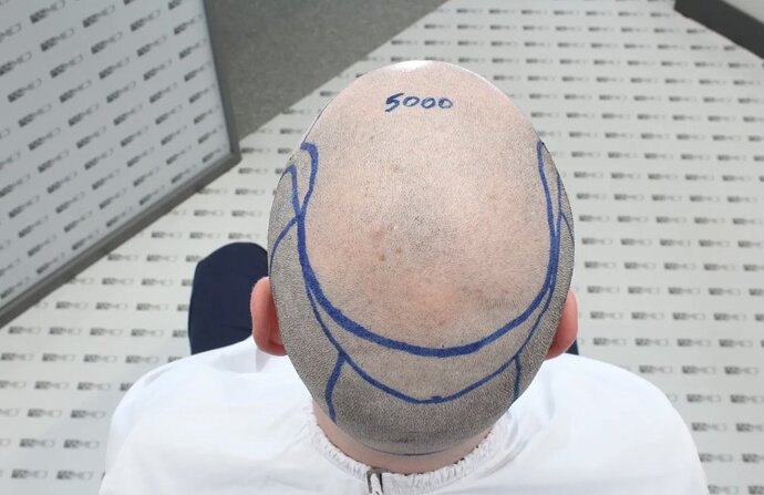 ASMED CLINIC CASE - DR.KORAY 5000 GRAFTS FUE photo