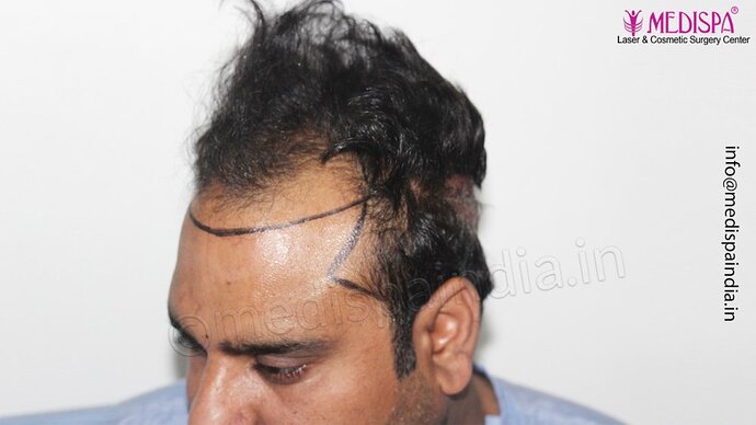 Dr. Suneet Soni - 4500 Grafts, 3 Year Result, NW-IV, Combine FUT + FUE Technique photo