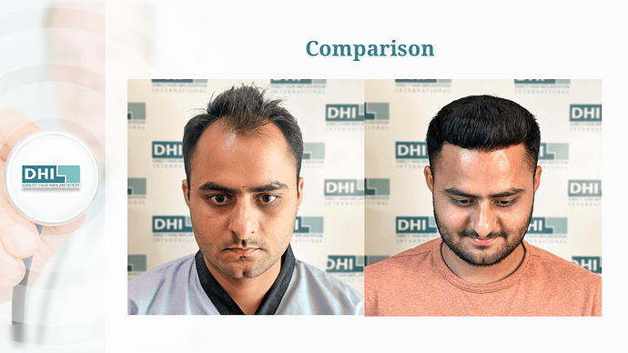 DHI India Result – 1784 Grafts photo