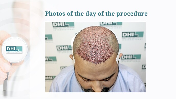 Full Scalp Coverage – 3,636 Grafts | DHI India Result photo