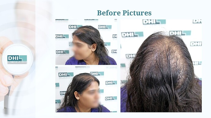 Female Hair Transplant | 1,359 Grafts | 6-Months Result | DHI India™ photo