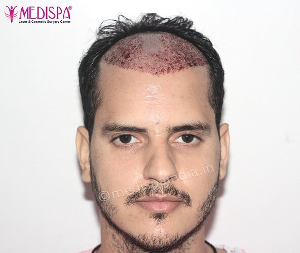 Dr. Suneet Soni - 2500 FUE Grafts, NW- III photo