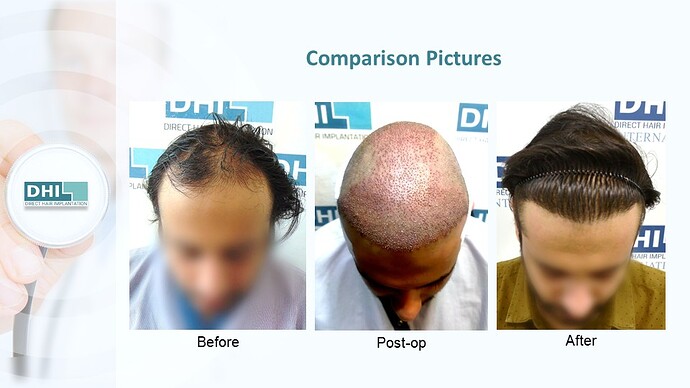 DHI India™ | NW 4 | 3,714 Grafts | 2 Years DHI Hair Transplant Result photo